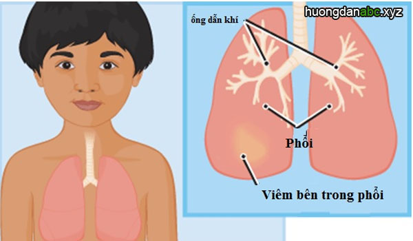 viêm phổi ở trẻ, cách phòng viêm phổi ở trẻ, điều trị viêm phổi ở trẻ