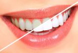 Răng trắng sáng nhờ nguyên liệu đơn giản ngay tại nhà
